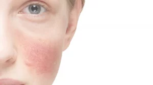 rosácea dermatoscopia