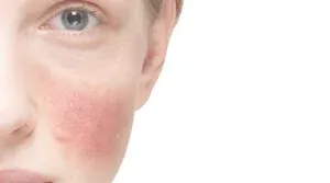 rosácea dermatoscopia